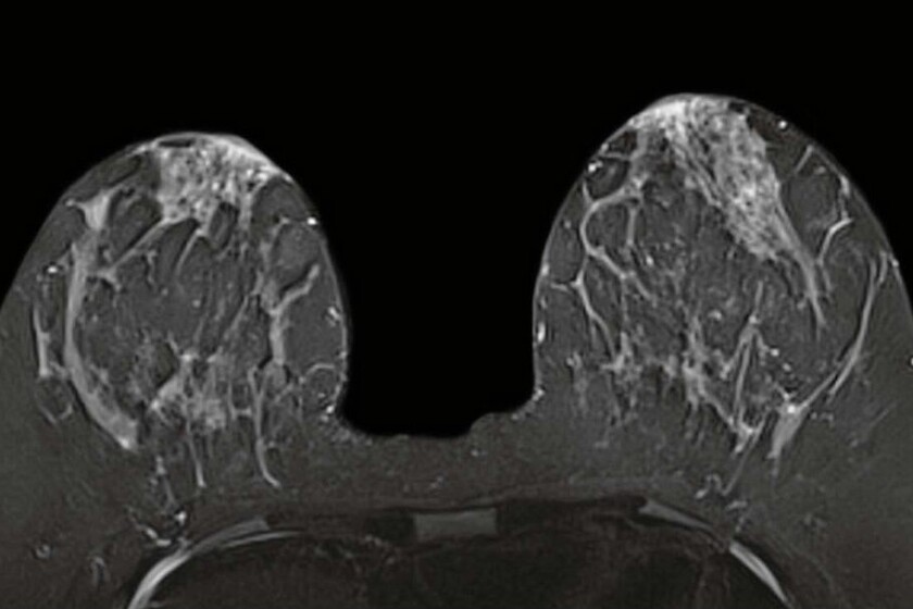 Breast-MRI image-CROP.jpg
