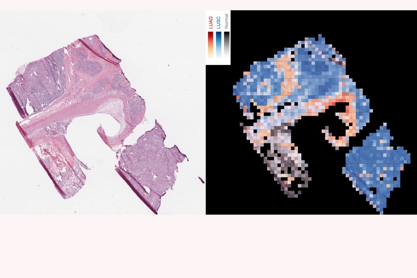 Tumor-analysis-CROP.jpg