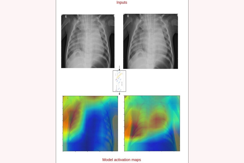 X-ray-pneumonia-CROP.jpg