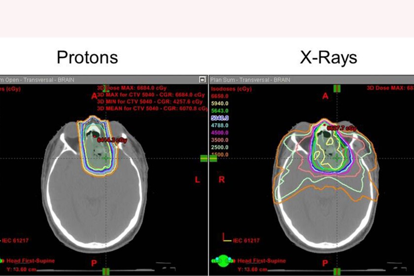 Proton-therapy-margins-CROP.jpg