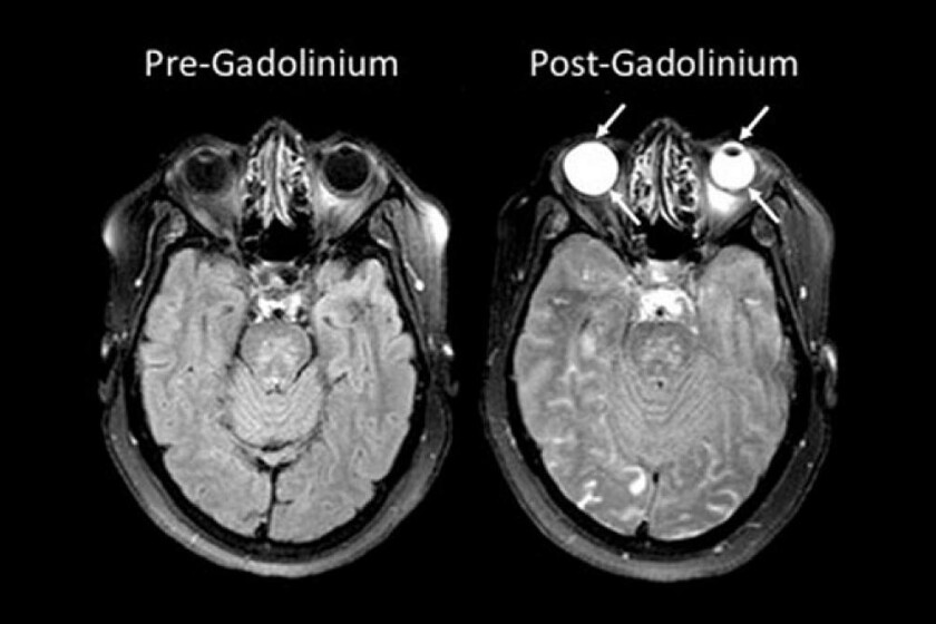 Stroke-imaging-CROP.jpg