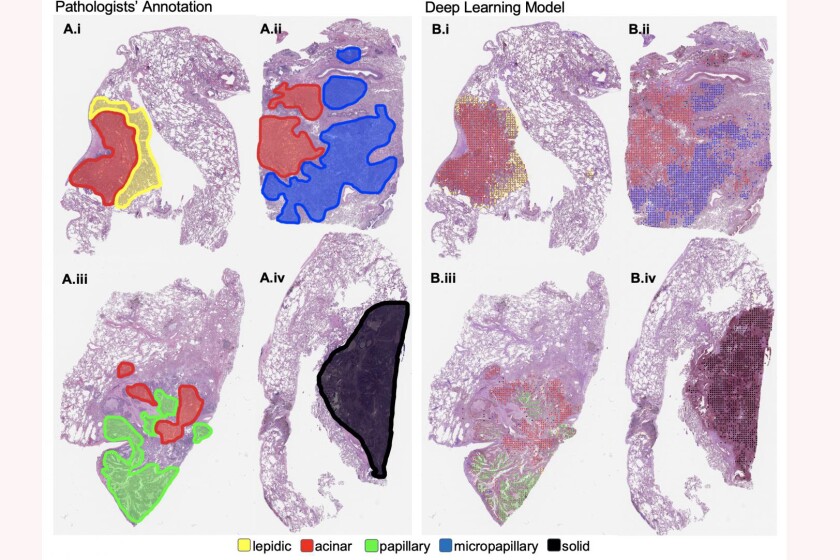 Whole Slide Images Lung Cancer-CROP.jpg
