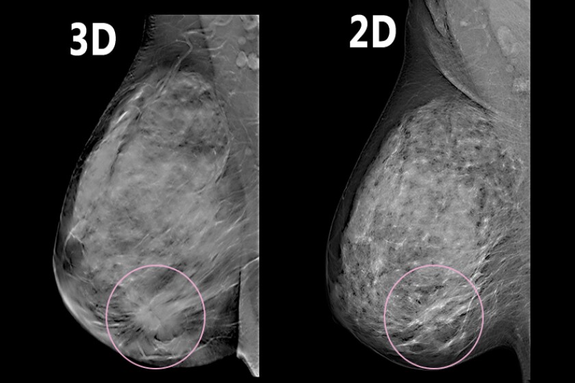 3D-mammography-CROP.jpg