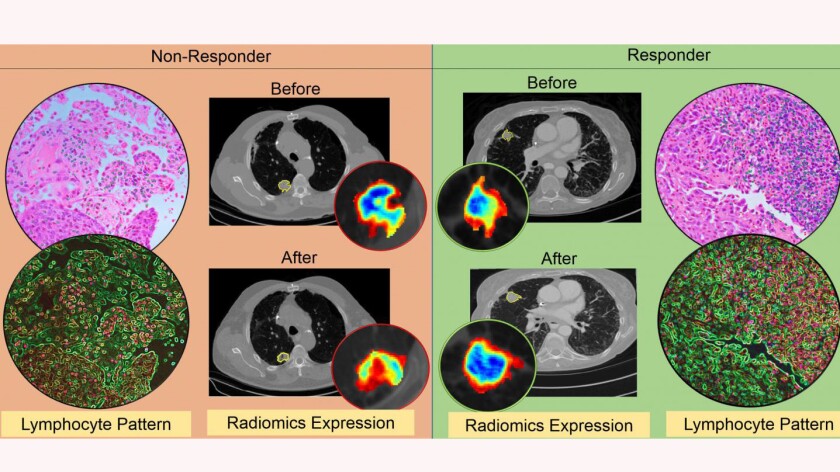 CT radiomic patterns-CROP.jpg