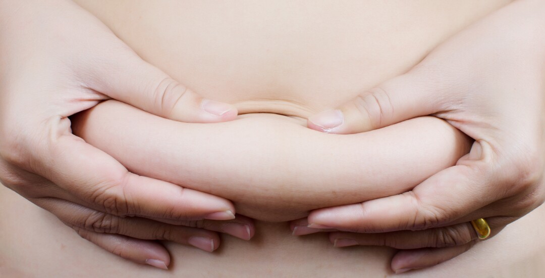 Tummy tuck
